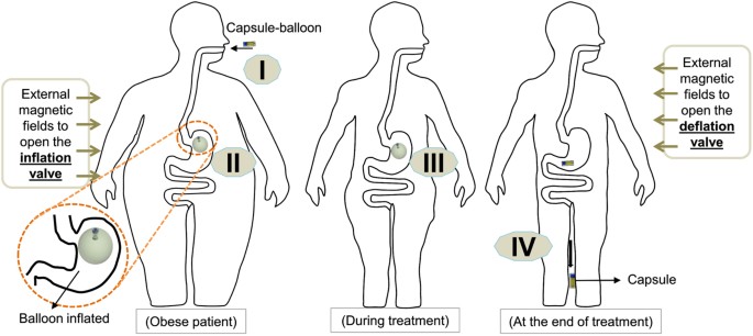 A Magnetic Soft Endoscopic Capsule-Inflated Intragastric Balloon for Weight  Management | Scientific Reports