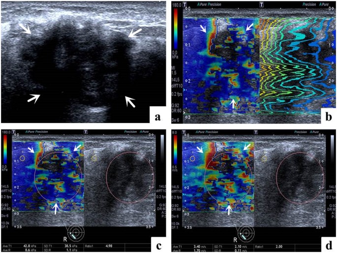 Qualitative and quantitative analysis with a novel shear wave