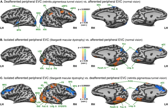 Reorganization of early visual cortex functional connectivity following  selective peripheral and central visual loss