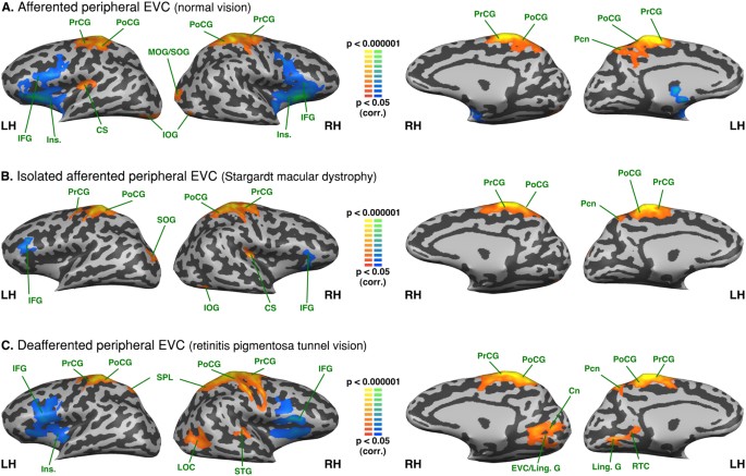 Reorganization of early visual cortex functional connectivity