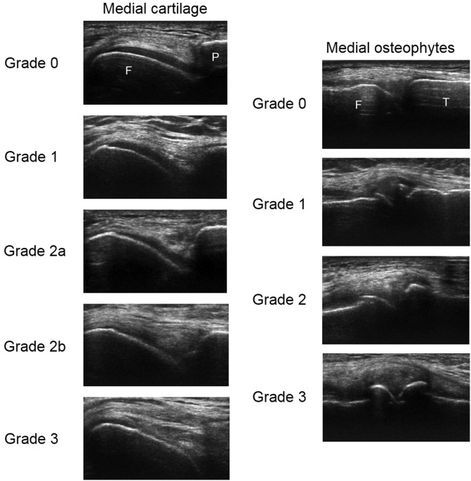 Structure-symptom relationship with wide-area ultrasound scanning of knee  osteoarthritis