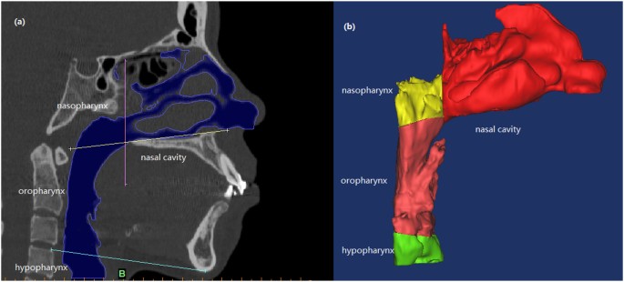 Computational fluid dynamics simulation of the upper airway 