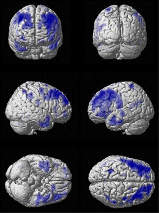 Elevated body mass in national football league players linked to cognitive impairment and decreased prefrontal cortex and temporal pole activity