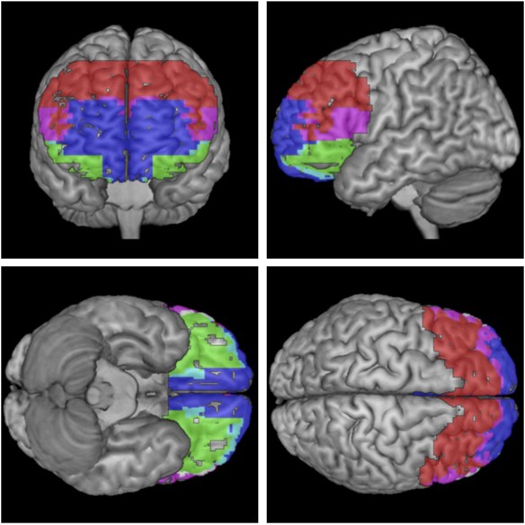 Prefrontal cortex markers of suicidal vulnerability in mood disorders: a model-based structural neuroimaging study with a translational perspective