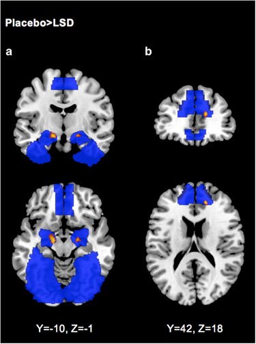 Acute Effects Of Lsd On Amygdala Activity During Processing Of Fearful Stimuli In Healthy Subjects Translational Psychiatry