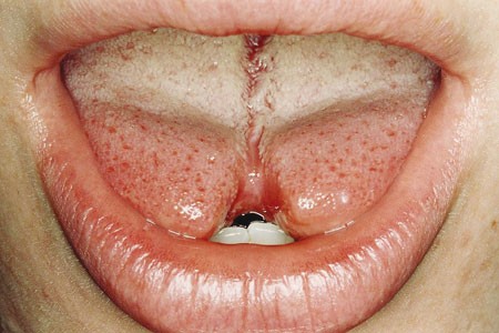 Tongue healing split Heal Cuts