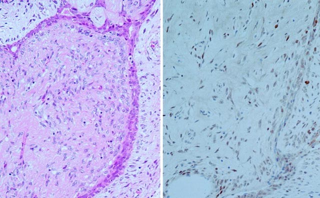 Increased p53 protein expression in malignant mammary phyllodes tumors