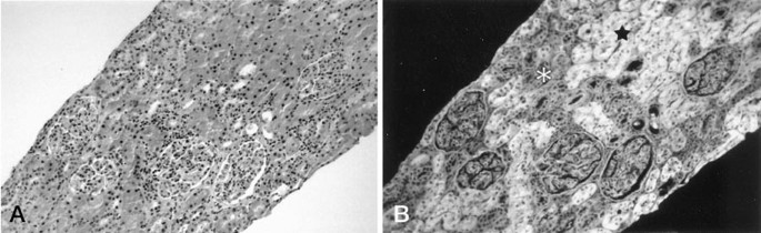 Microscopic view of kidney tissue showing immune cell infiltration