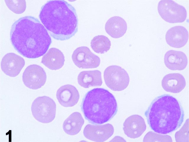 Mantle Cell Lymphoma With 8q24 Chromosomal Abnormalities A Report Of 5 Cases With Blastoid Features Modern Pathology