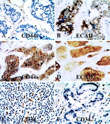 Expression of cell adhesion molecules, cd44s and e-cadherin, and microvessel density in carcinoid tumors