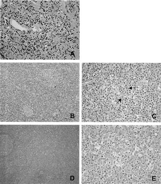 Involvement Of The Chromosomal Translocation T 11 18 In Some Mucosa Associated Lymphoid Tissue Lymphomas And Diffuse Large B Cell Lymphomas Of The Ocular Adnexaevidence From Multiplex Reverse Transcriptase Polymerase Chain Reaction And Fluorescence In
