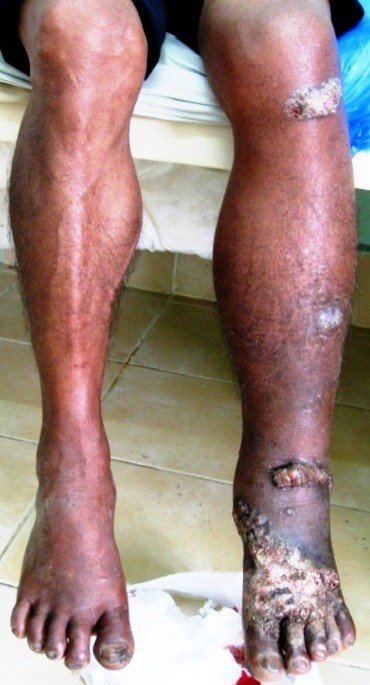 Chromoblastomycosis after a leech bite complicated by myiasis: a case  report | BMC Infectious Diseases | Full Text