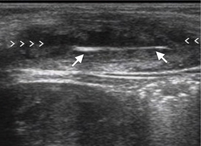 Non-opaque soft tissue foreign body: sonographic findings | BMC Medical  Imaging | Full Text