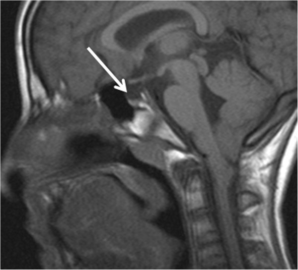 Clinical and mutational spectrum in Korean patients with Rubinstein–Taybi  syndrome: The spectrum of brain MRI abnormalities - ScienceDirect