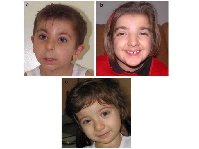 Molecular studies in 10 cases of Rubinstein-Taybi syndrome