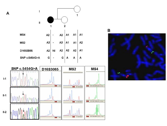 Microdeletions and mutations of CREBBP (CBP) gene can cause