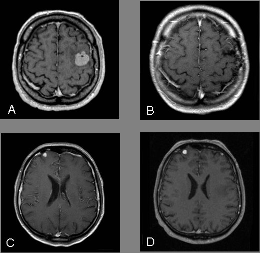 Brain metastases as primary manifestation of a melanocytic malignant peripheral  nerve sheath tumor in a 60-year-old man | BMC Neurology