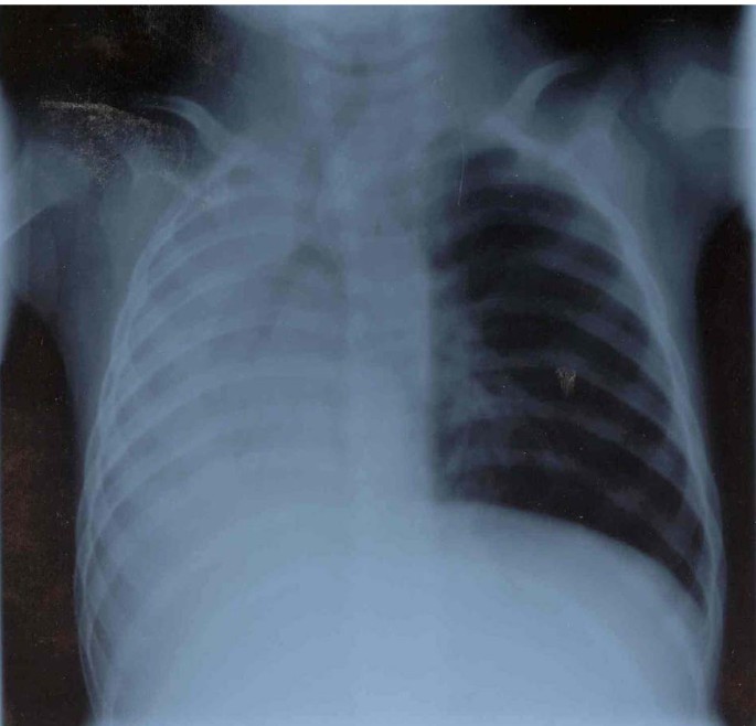 Massive lung collapse with partial resolution after several years: a case  report | BMC Pediatrics | Full Text