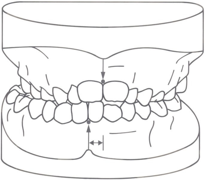 Spine deviations and orthodontic treatment of asymmetric