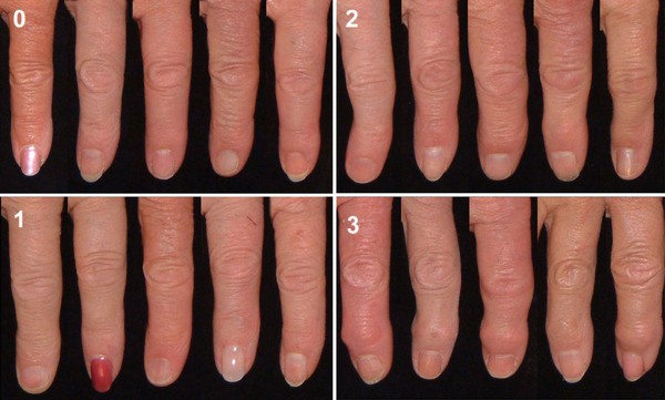 Risk factors for the progression of finger interphalangeal joint  osteoarthritis: a systematic review