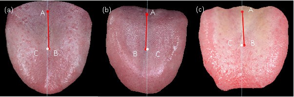 Analysis of using the tongue deviation angle as a warning sign of a stroke  | BioMedical Engineering OnLine | Full Text