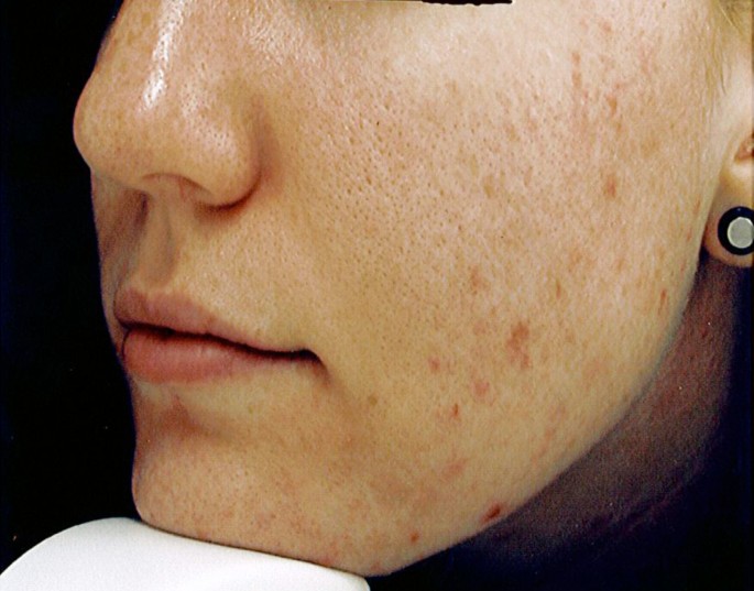 Acne vulgaris, mental health and omega-3 fatty acids: a report of cases |  Lipids in Health and Disease | Full Text