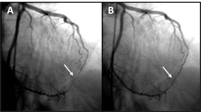 Update on Myocardial Bridging