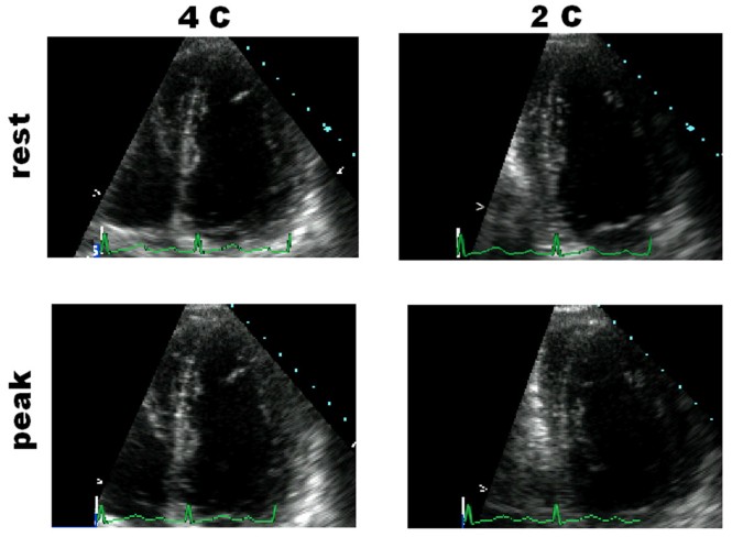 Second-opinion stress tele-echocardiography for the Adonhers (Aged donor  heart rescue by stress echo) project | Cardiovascular Ultrasound | Full Text
