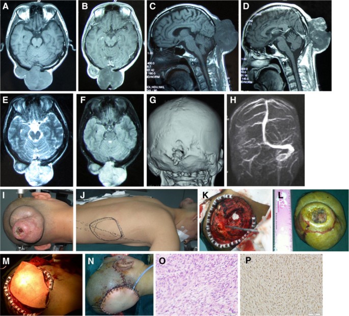 metastatic melanotic peripheral nerve sheath sarcoma prognosis Microsurgical management of giant malignant peripheral nerve sheath tumor  of the scalp: two case reports and a literature review | World Journal of  Surgical Oncology