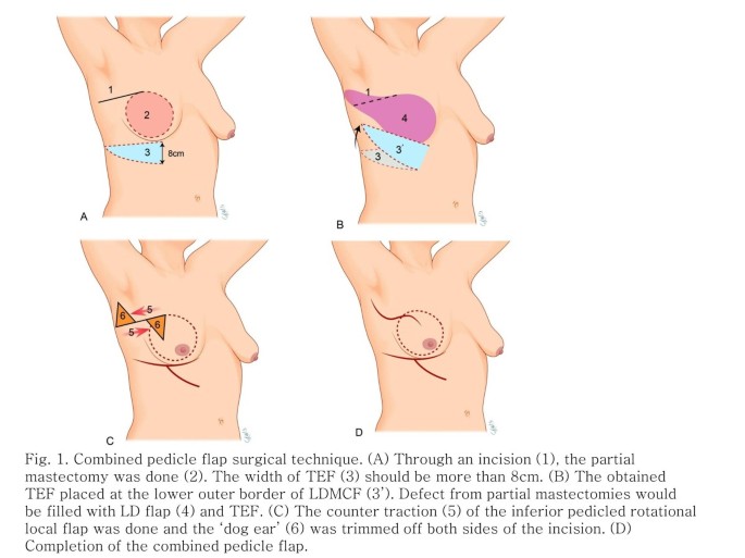 Patient F - Bilateral Breast Reconstruction following Breast Cancer -  Patient's left breast was previously reconstructed following a left breast  mastectomy, radiation, and a latissimus flap. — Dr Giuffre Plastic Surgeon  Edmonton