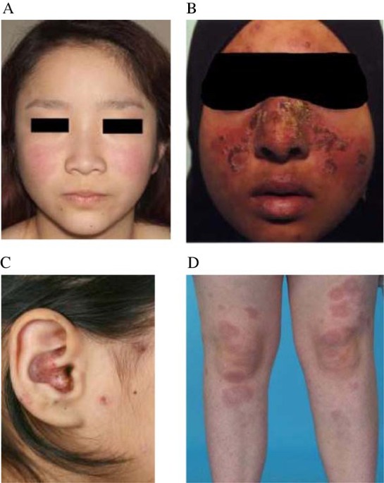 Mucocutaneous manifestations in juvenile-onset systemic lupus erythematosus:  a review of literature | Pediatric Rheumatology | Full Text