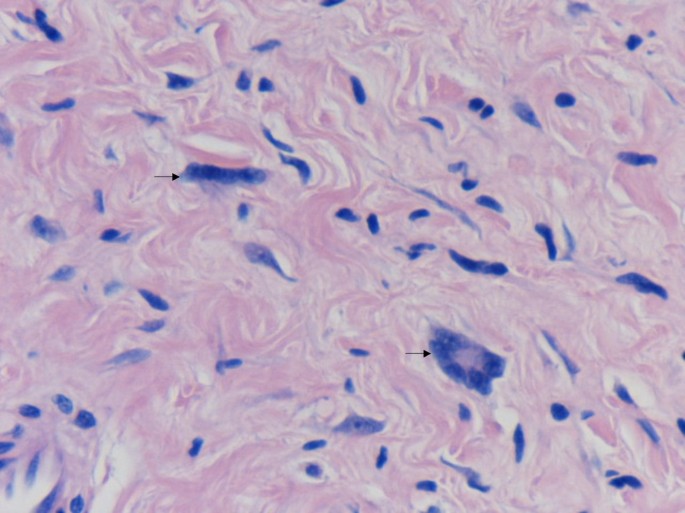 JCDR - Floret giant cells, Ropey collagen, Soft tissue neoplasm