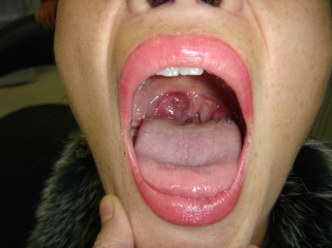 Extramedullary plasmacytoma