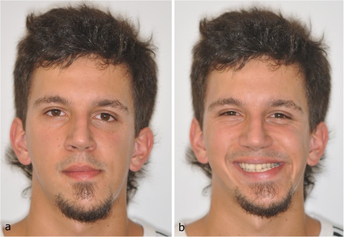 Correction of a severe facial asymmetry with computerized planning and with  the use of a rapid prototyped surgical template: a case report/technique  article | Head & Face Medicine | Full Text