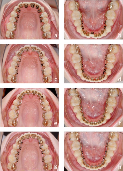 Orthodontic Treatment Process