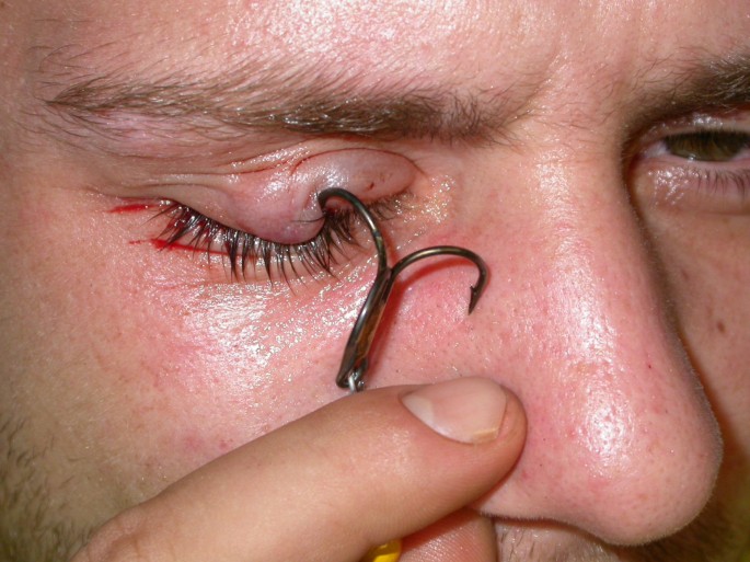 fight getting fish hooked Fish-hook injuries: a risk for fishermen | Head & Face Medicine
