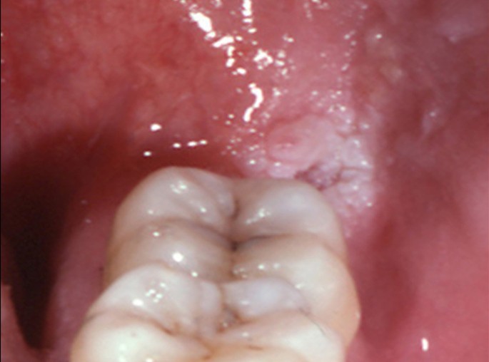 what part of the tobacco plant is used Alveolar ridge keratosis - a retrospective clinicopathological study | Head  & Face Medicine