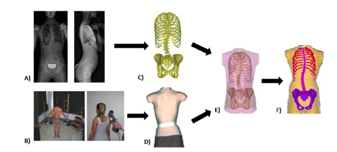 Improved brace design combining CAD/CAM and finite element simulation for  the conservative treatment of adolescent idiopathic scoliosis (AIS):  preliminary results of a randomized control trial, Scoliosis and Spinal  Disorders