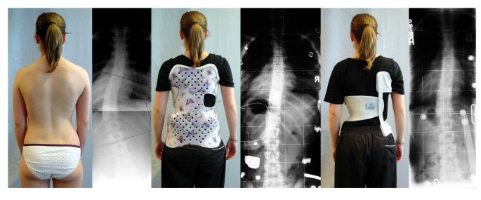Brace related stress in scoliosis patients – Comparison of different  concepts of bracing, Scoliosis and Spinal Disorders