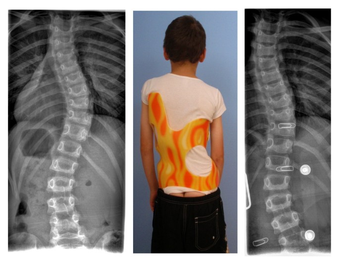 Boston Brace: First Check before X-Ray - Scoliosis and Spine