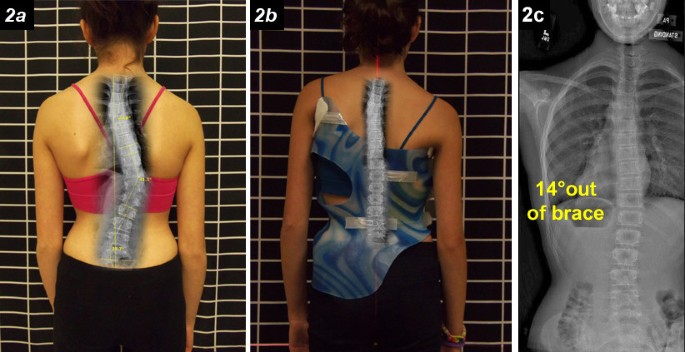Brace modifications that can result in improved curve correction in  idiopathic scoliosis, Scoliosis and Spinal Disorders