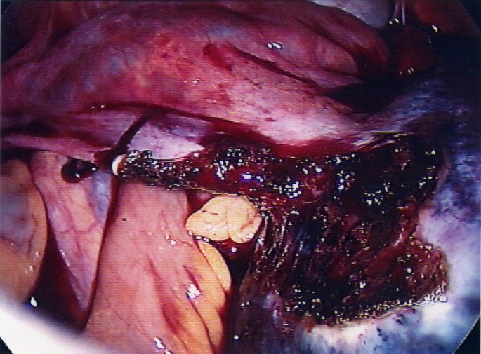 Laparoscopic resection of a torted ovarian dermoid cyst