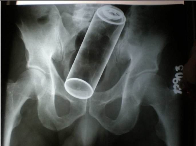 Management of rectal foreign bodies | World Journal of Emergency Surgery |  Full Text