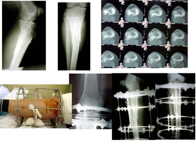 Full-ring Ilizarov frame applied for lengthening of tibia.