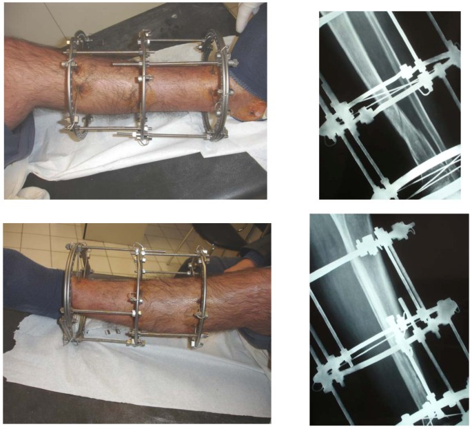 Fixation of ring fixator to proximal tibia. (a) Transverse wire