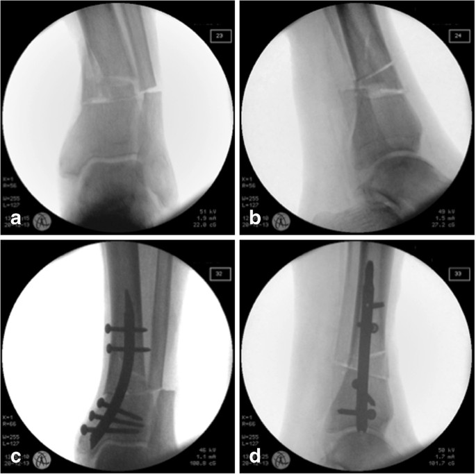 Figure 3 from Extending the indications of intramedullary nailing with the  Expert Tibial Nail. | Semantic Scholar