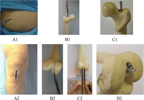 Femur Intramedullary Nail, High Quality Femur Intramedullary Nail on  Bossgoo.com