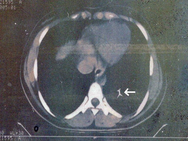 An interesting journey of an ingested needle: a case report and review of  the literature on extra-abdominal migration of ingested Foreign bodies, Journal of Cardiothoracic Surgery