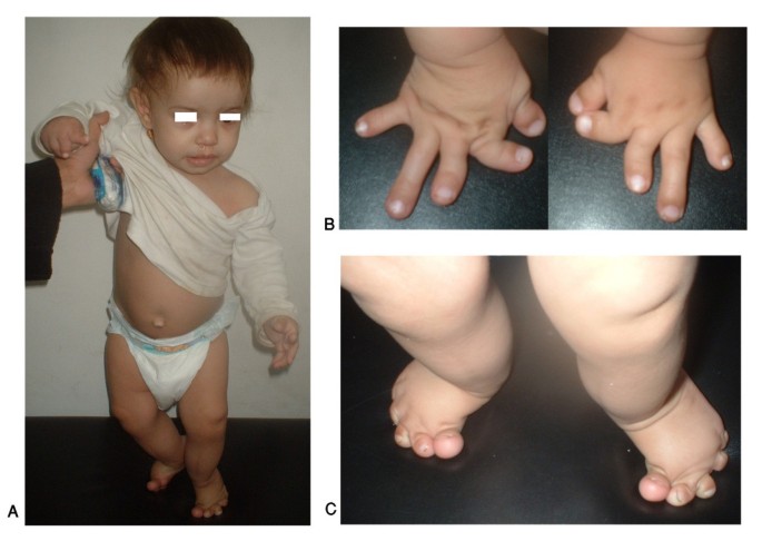 Brachydactyly, Orphanet Journal of Rare Diseases