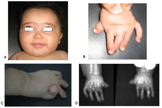 Brachydactyly, Orphanet Journal of Rare Diseases